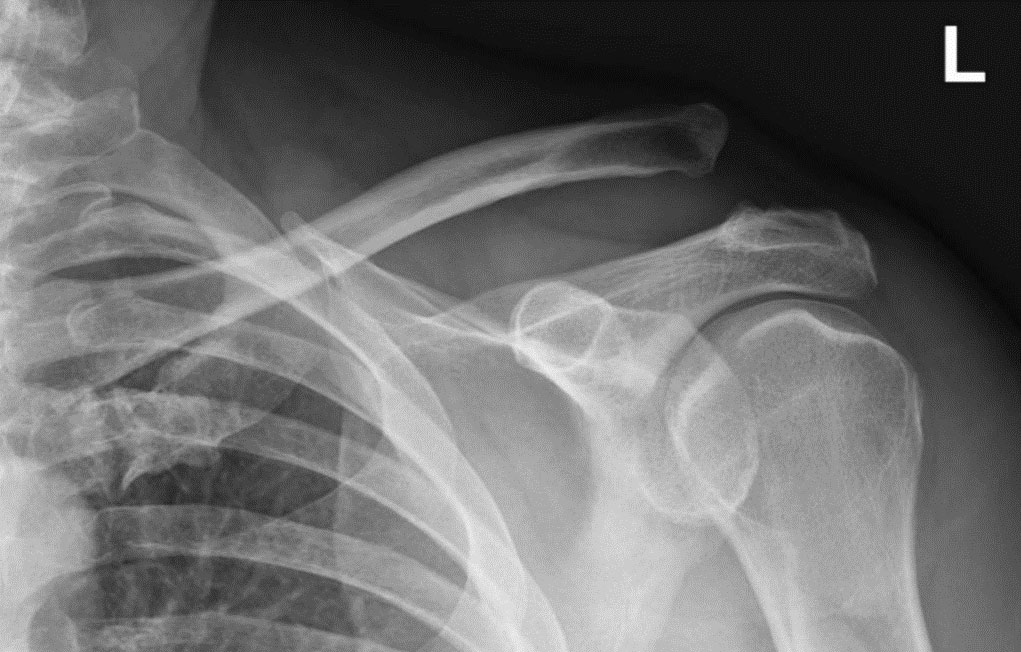 AC joint dislocation before surgery