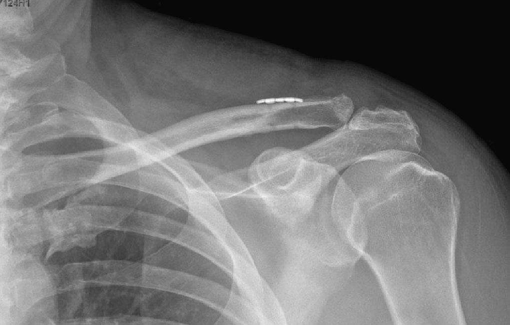 AC joint dislocation after surgery