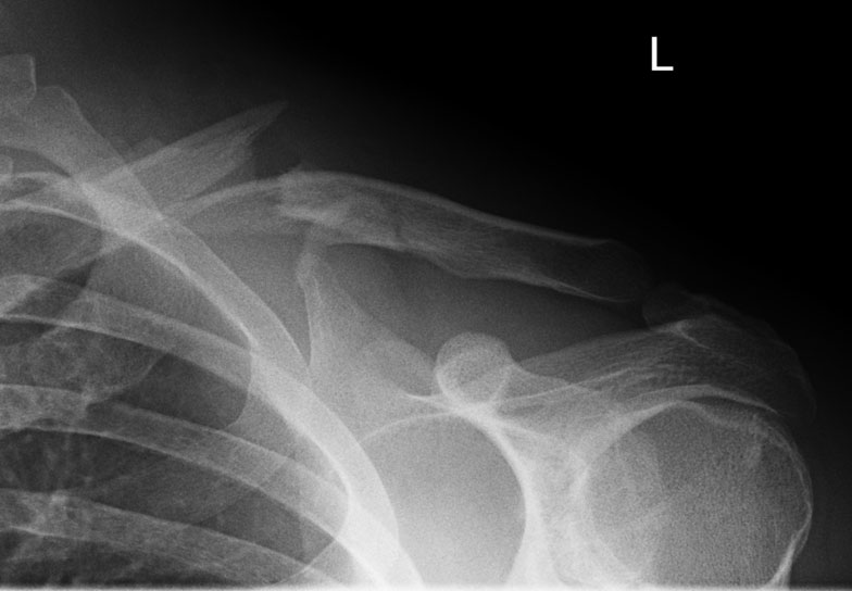 Comminuted fracture before surgery