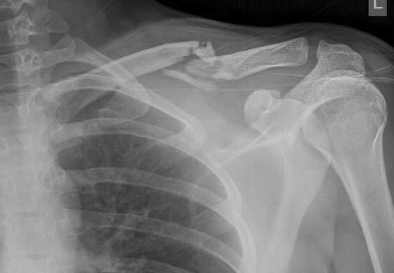 Comminuted fracture before surgery
