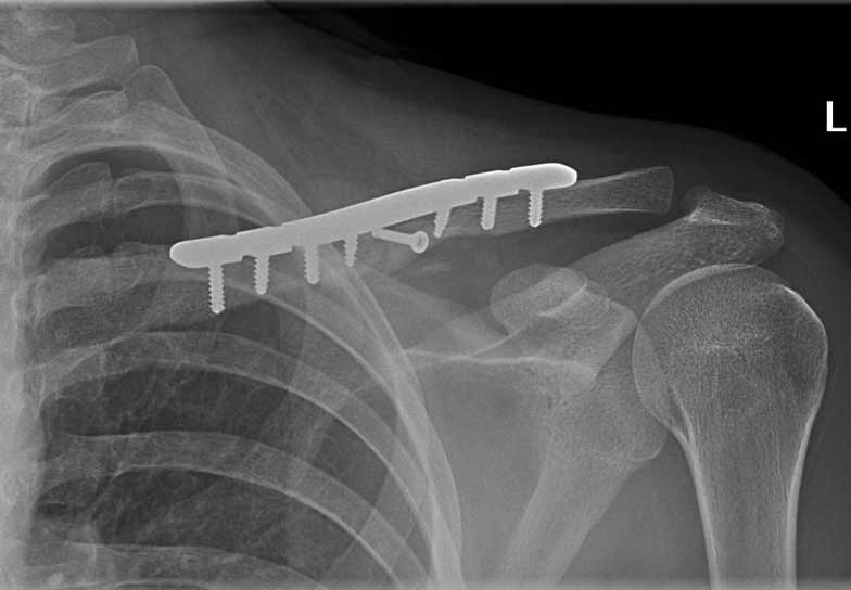 Comminuted fracture after surgery