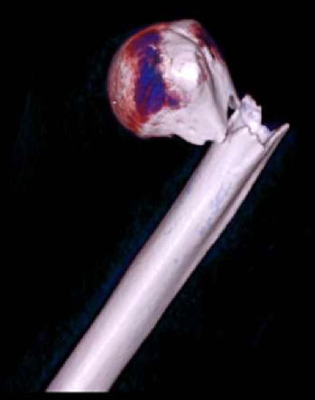 CT scan showing proximal humerus fracture