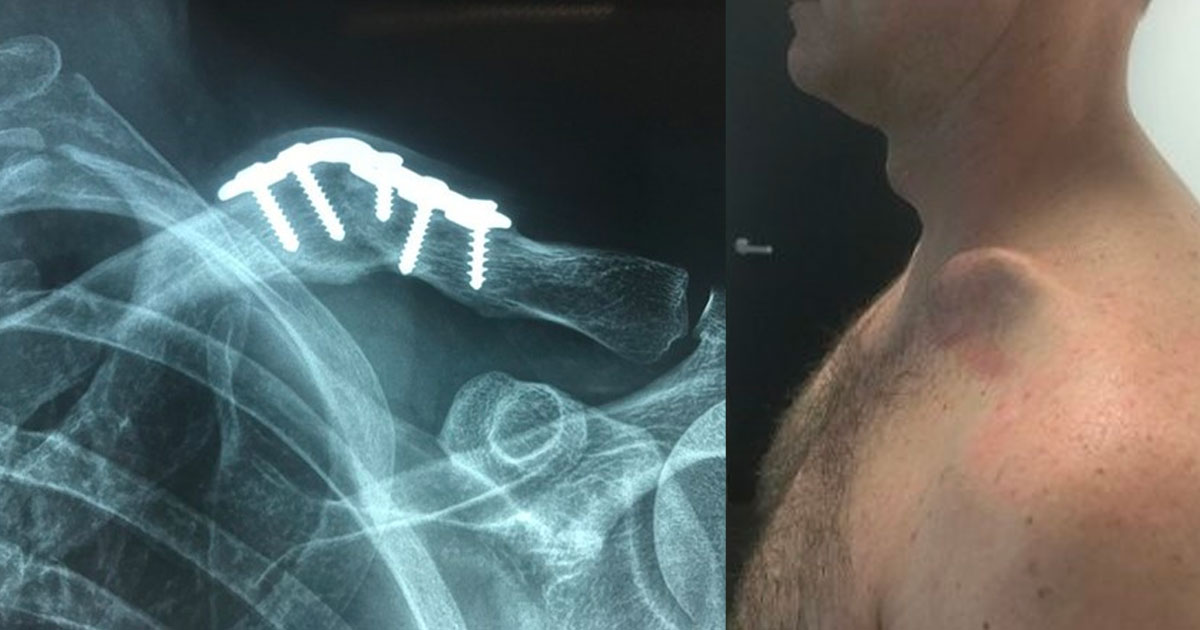 41 year old man who had broken his clavicle in a motor bike accident 20 years ago but has never felt right despite being 'fixed'
