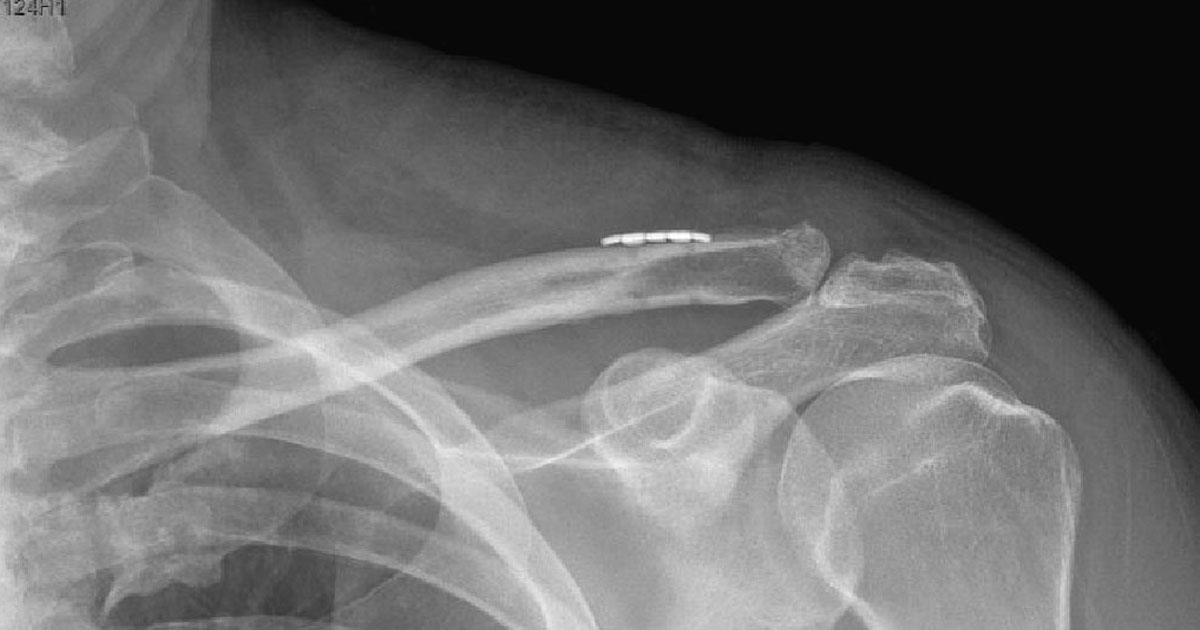Learn more about the stemless prosthesis used to replace the socket part of the shoulder joint during a primary shoulder replacement.
