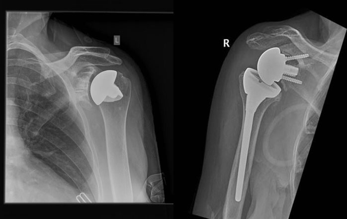 X-Rays of a standard shoulder replacement (left) and a reverse shoulder replacement (right)