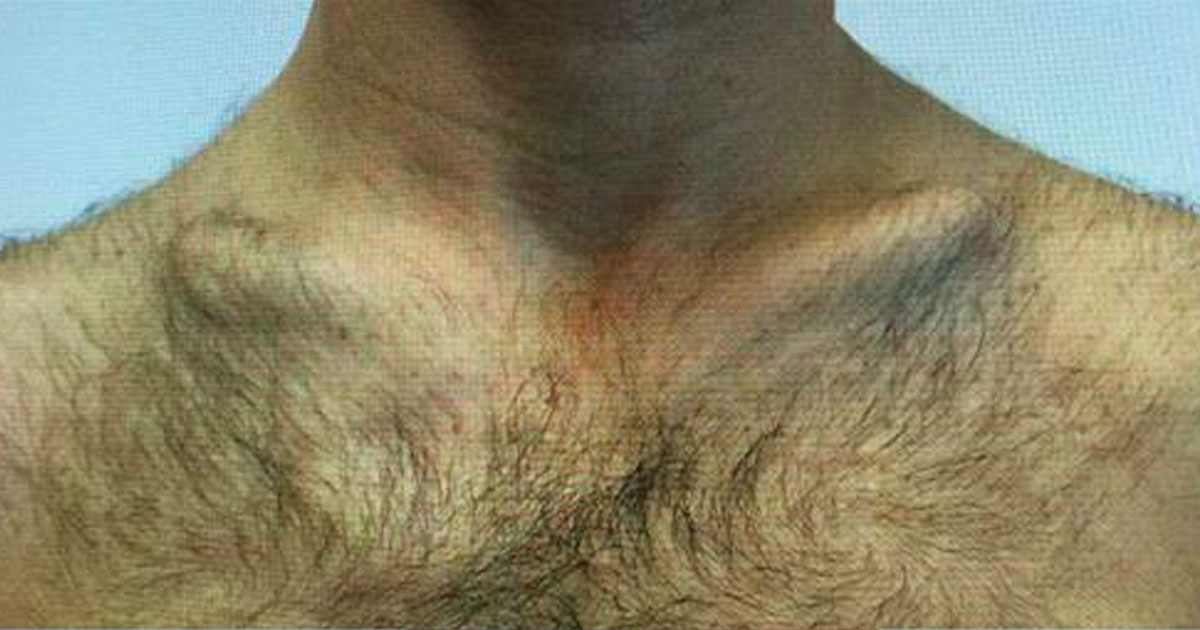 Old clavicle fracture before surgery