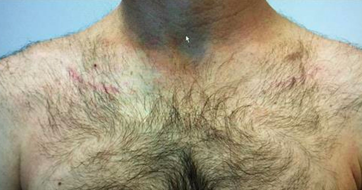 Old clavicle fracture after surgery