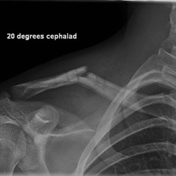 Clavicle fracture before initial surgery