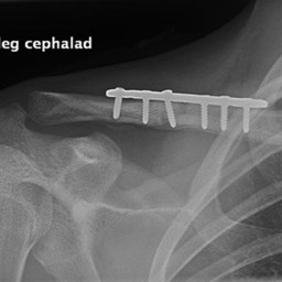 Clavicle fracture after initial surgery