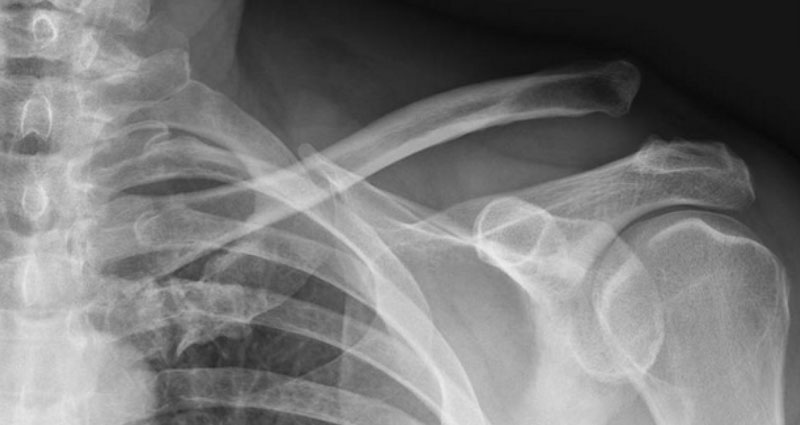 Xray showing an AC joint dislocation