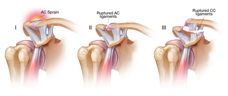 Anatomical drawing showing the 3 types of AC joint tears