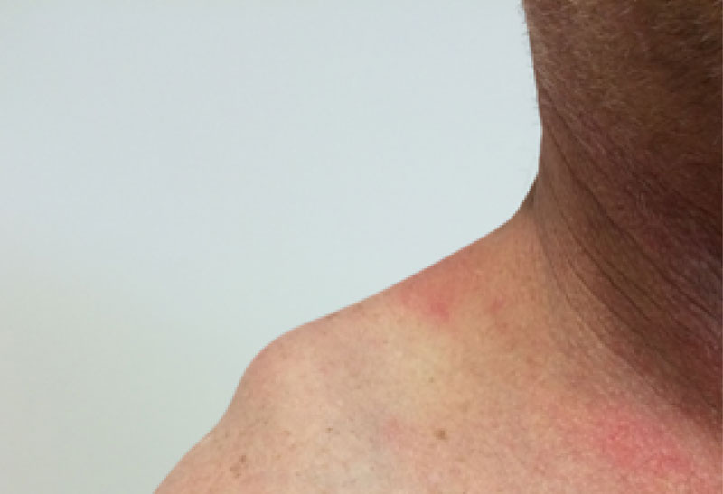 Photograph showing a promiment bump caused by a clavicle out of joint
