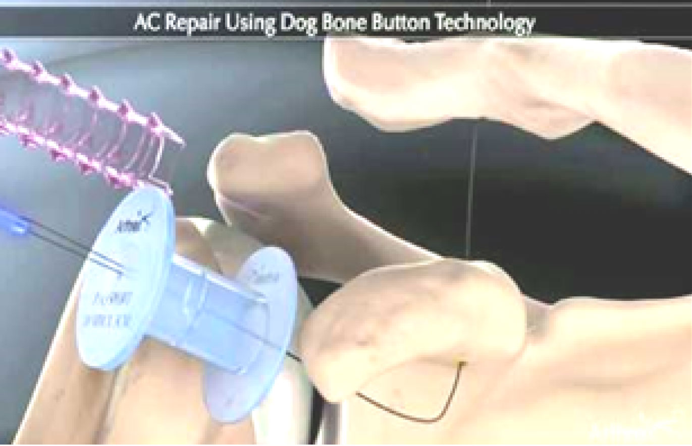 Drawing of a Dog Bone button userd in AC joint reconstruction surgery