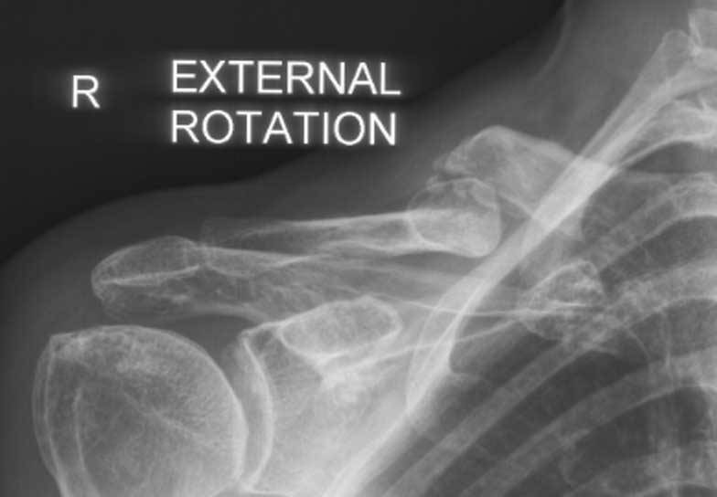 Malunion fracture before surgery