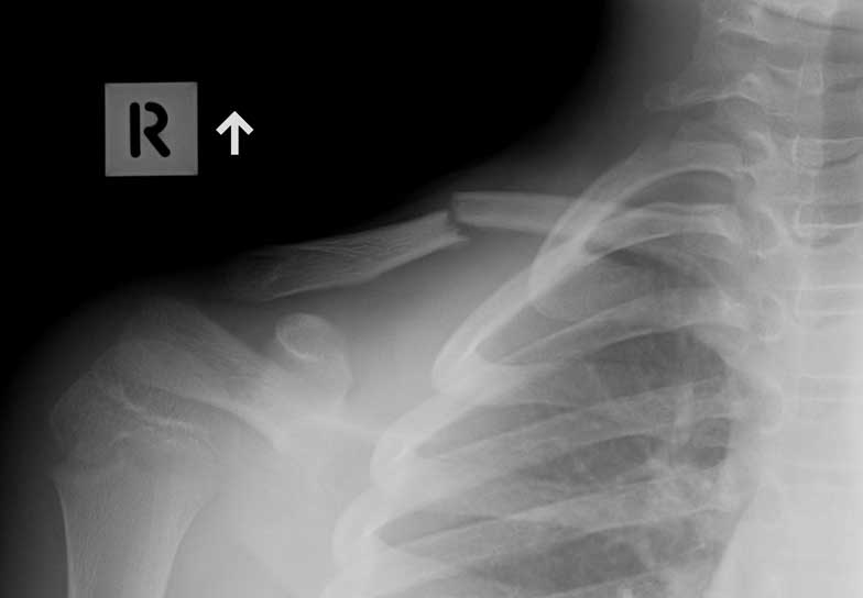 Malunion fracture before surgery