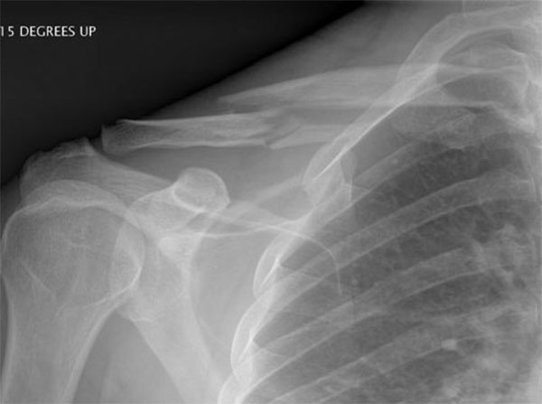 Malunion fracture before surgery