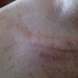 Clavicle Surgery Scar