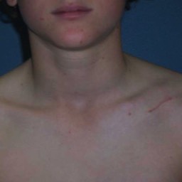 Clavicle Surgery Scar