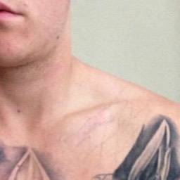 Clavicle Surgery Scar