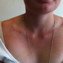 Clavicle Surgery Scar