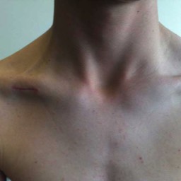 Clavicle Surgery Scar