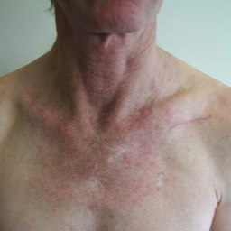 Clavicle Surgery Scar