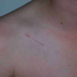 Clavicle Surgery Scar