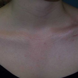 Clavicle Surgery Scar