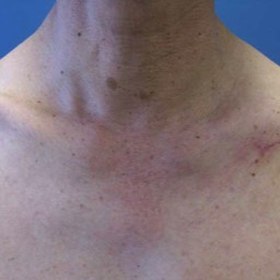 Clavicle Surgery Scar