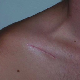 Clavicle Surgery Scar