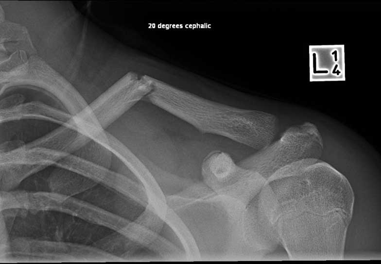Angulated fracture before surgery