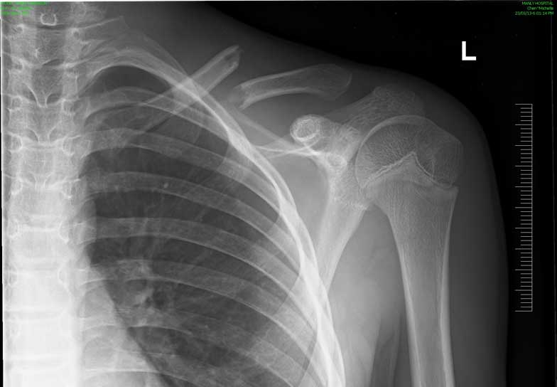 DIsplaced fracture before surgery