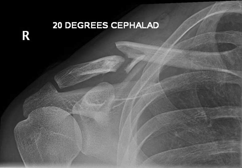 Comminuted fracture before surgery