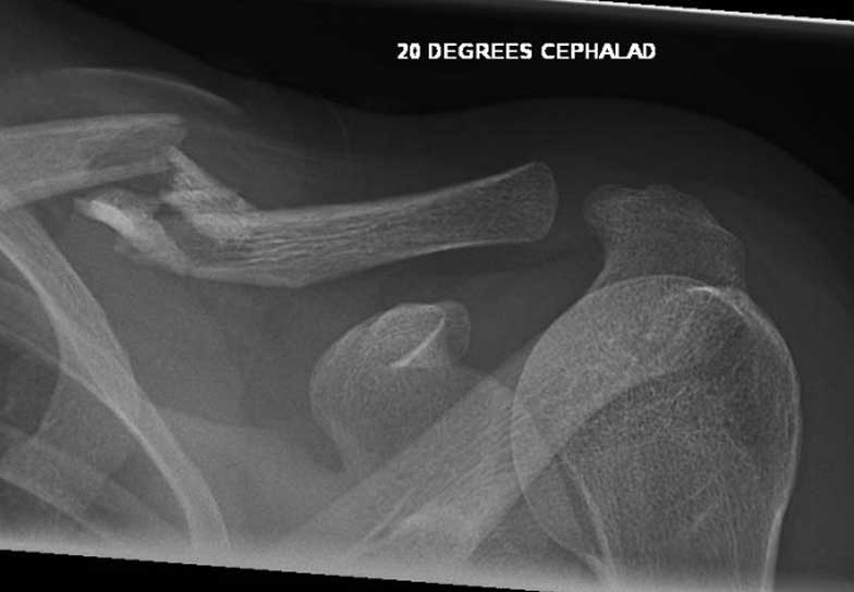 Comminuted fracture before surgery
