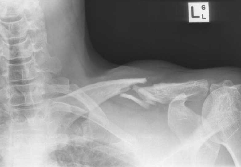 Comminuted fracture before surgery