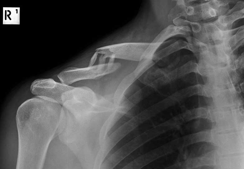 Comminuted fracture before surgery