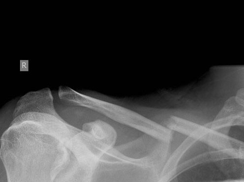 Comminuted fracture before surgery