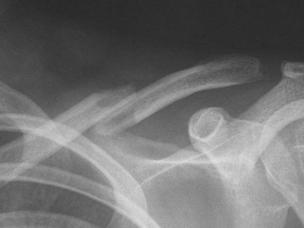 DIsplaced fracture before surgery