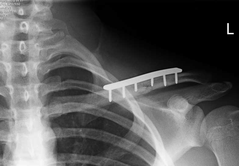 Clavicle Fractures Dr David Duckworth