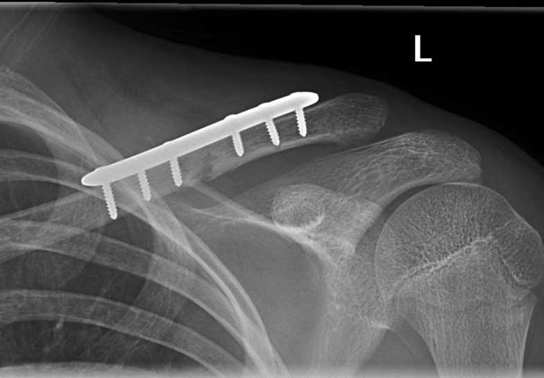 DIsplaced fracture after surgery