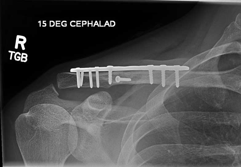 Comminuted fracture after surgery