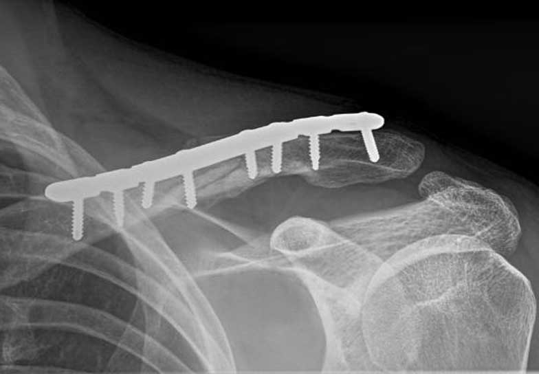 Comminuted fracture after surgery