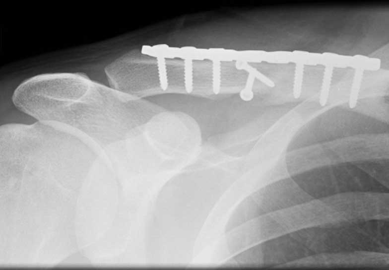 Comminuted fracture after surgery