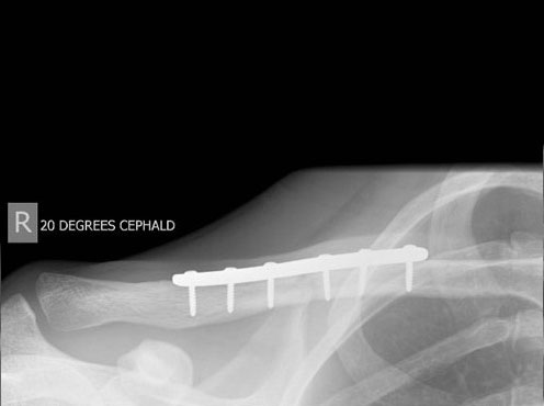 Comminuted fracture after surgery