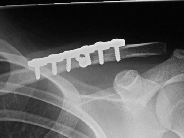 DIsplaced fracture after surgery
