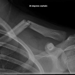 Clavicle Fracture Treatment Sydney