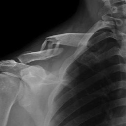 Clavicle Fracture Treatment Sydney