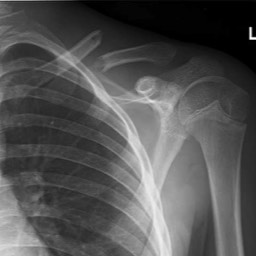 Clavicle Fracture Treatment Sydney