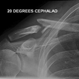 Clavicle Fracture Treatment Sydney