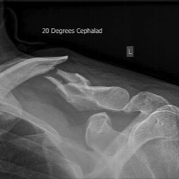 Clavicle Fracture Treatment Sydney